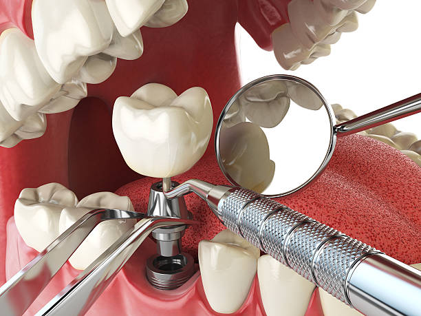 Best Emergency Tooth Extraction in Fair Oaks, VA