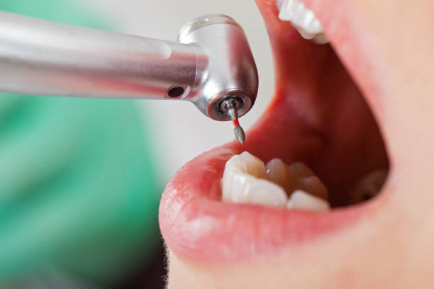 Best Emergency Tooth Extraction in Fair Oaks, VA